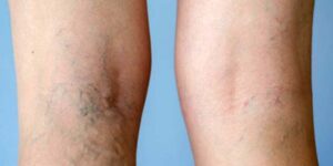 Varicose Veins